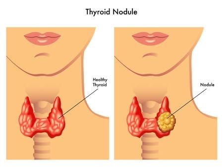 NaturalyPure GoiterX Thyroid Support - 90 Vegetarian Capsules - image 5