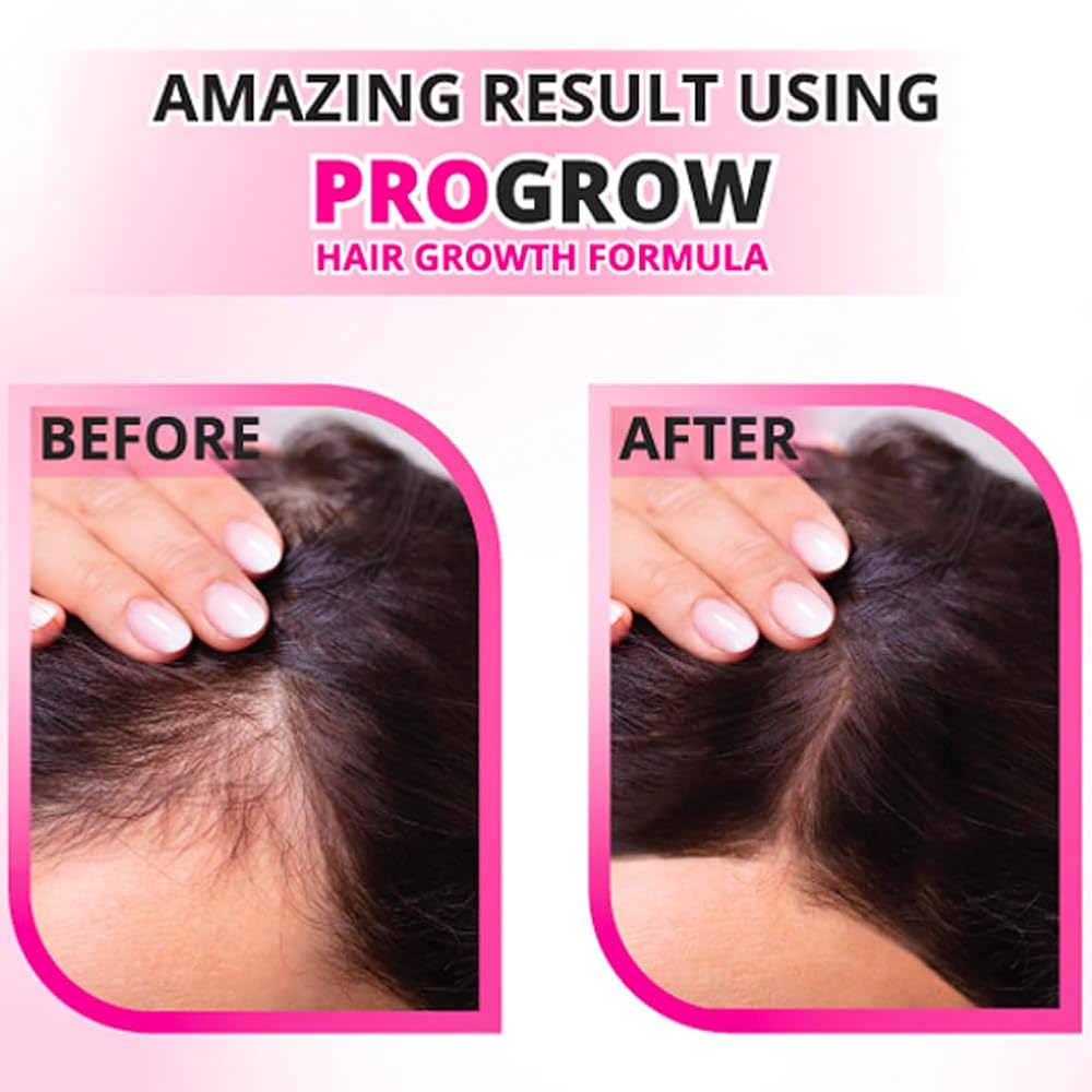 UNG ProGrow Hair Growth Formula for Male & Female Pattern Baldness - 60 Capsules - image 4