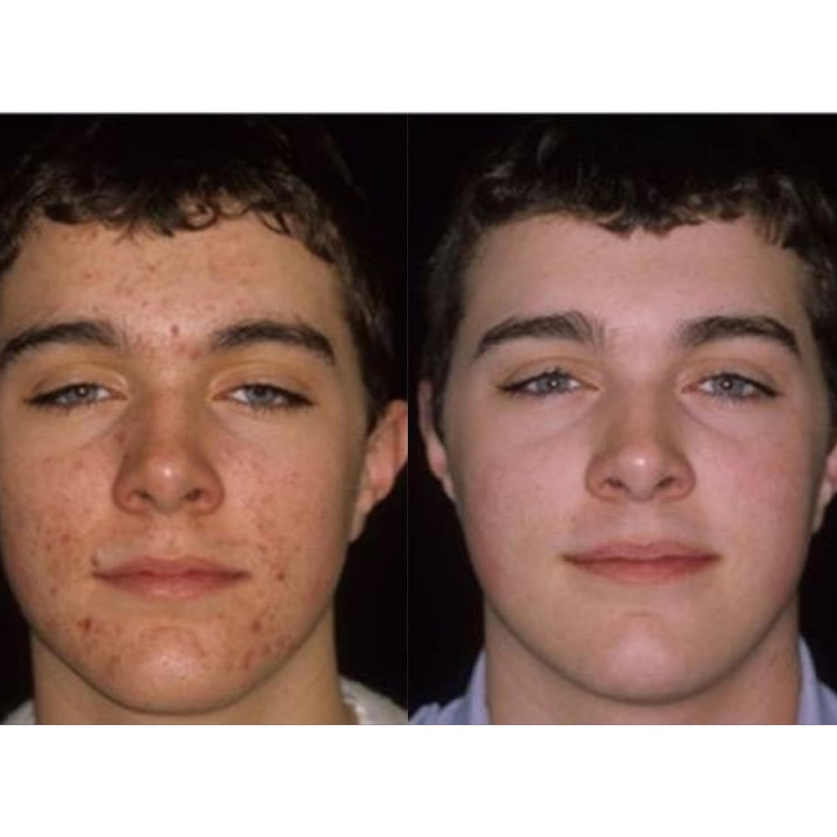 Acnetame Acne Pills Supplement for Skin Clarity - 60 Tablets - image 4