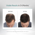PEAK VITALS DHT Blocker Hair Growth Formula - 90 Capsules - image 7
