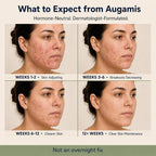 Augamis Hormonal Acne Treatment for Women - No DIM - (60 Capsules