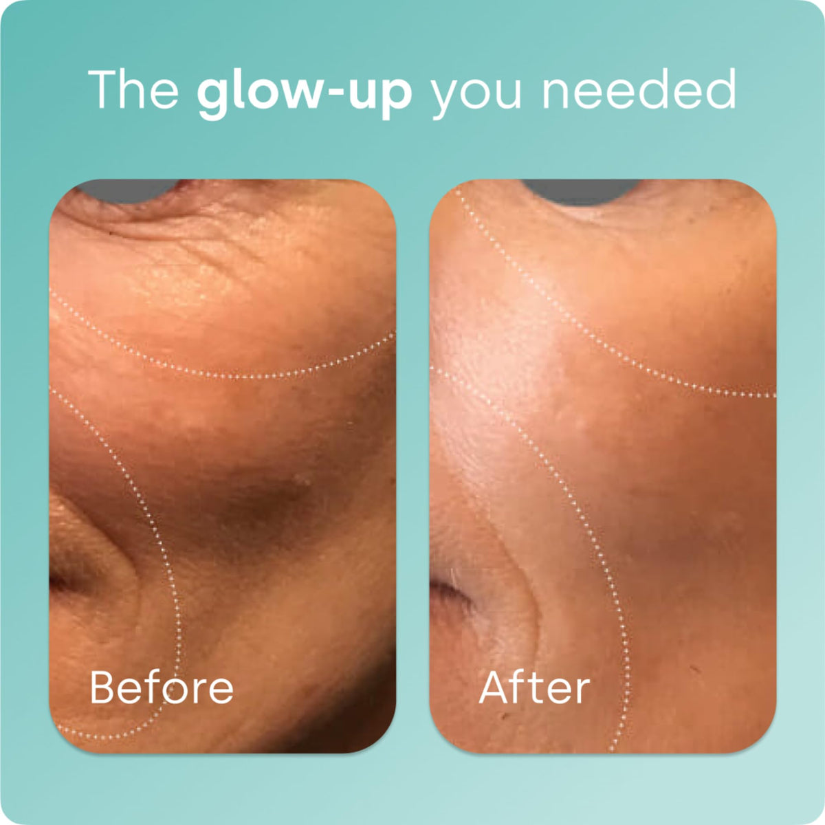 Biosil Collagen Generator - Original Capsules - with Patented ch-OSA