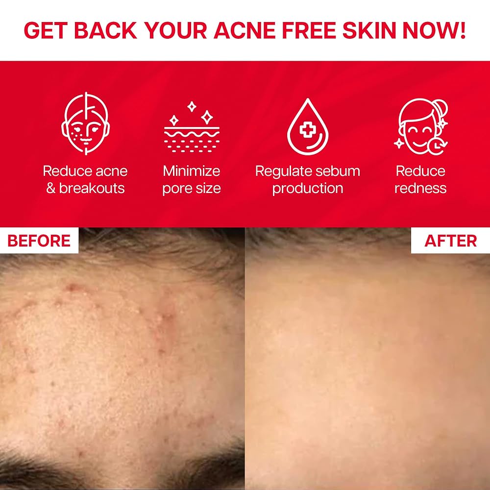 Ventamin Clear It+ Acne Supplement with Probiotics & Zinc - 30 Sachets - image 5