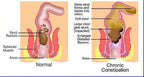 The One Minute Miracle - Miracle Oxy-Cleanse Colon Cleanse for 1