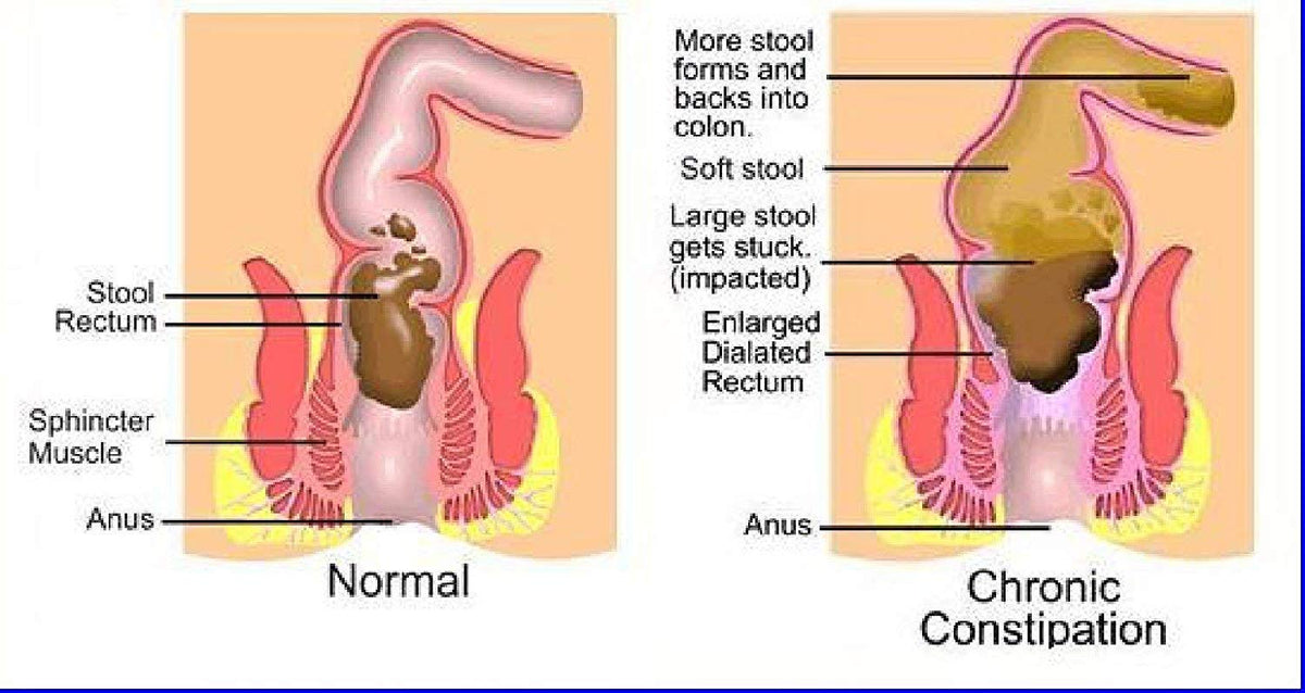 The One Minute Miracle - Miracle Oxy-Cleanse Colon Cleanse for 1