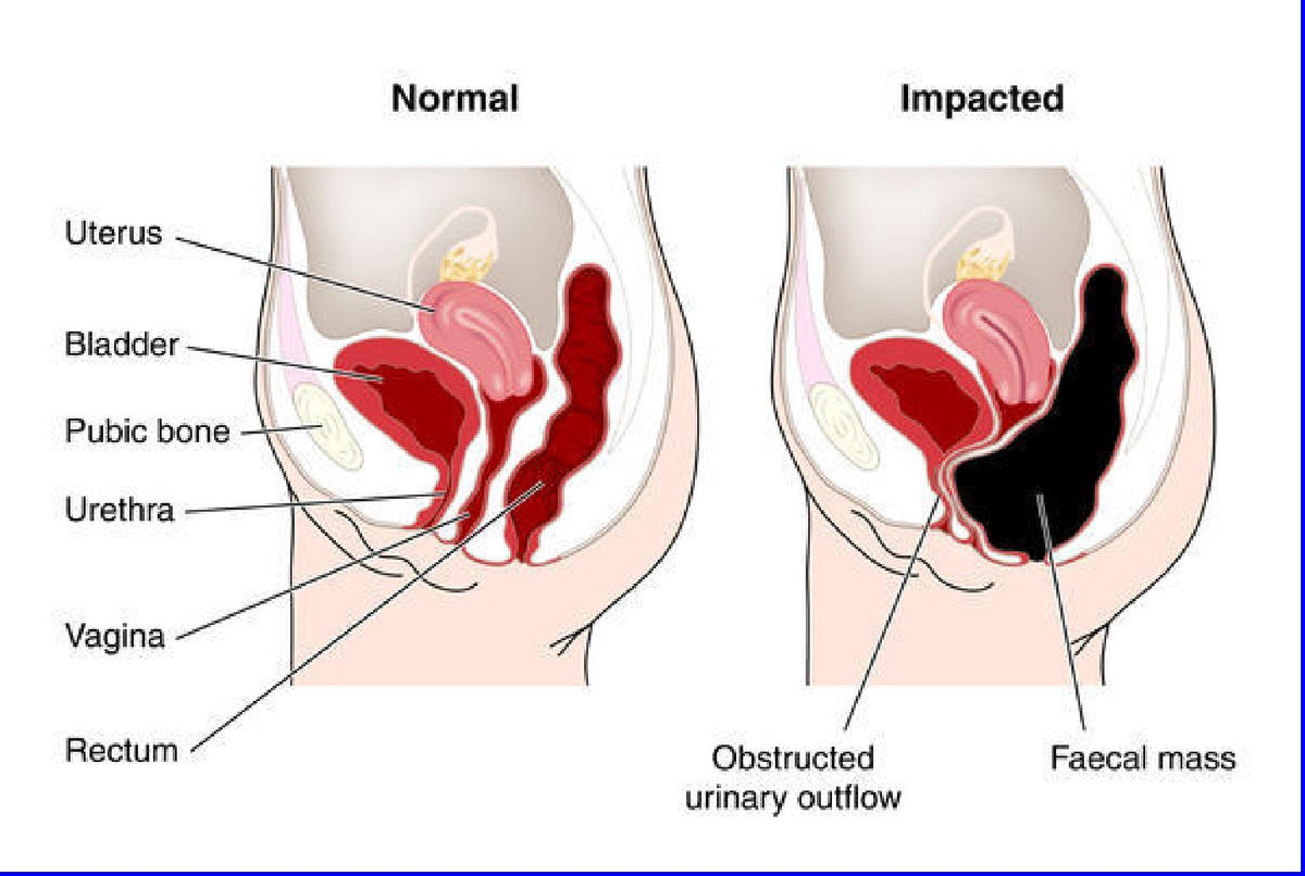 The One Minute Miracle - Miracle Oxy-Cleanse Colon Cleanse for 1
