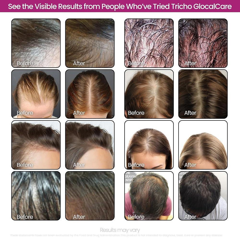 GlocalCare Tricho Hair Growth Supplement with Biotin & Saw Palmetto - image 8