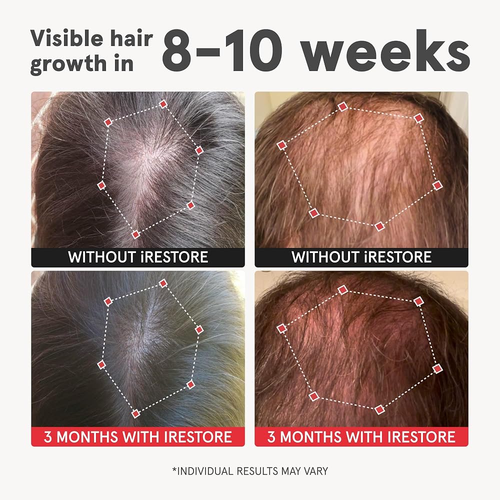 iRestore Advanced Hair Growth Supplement for Women with Lustriva - 120 Capsules - image 2