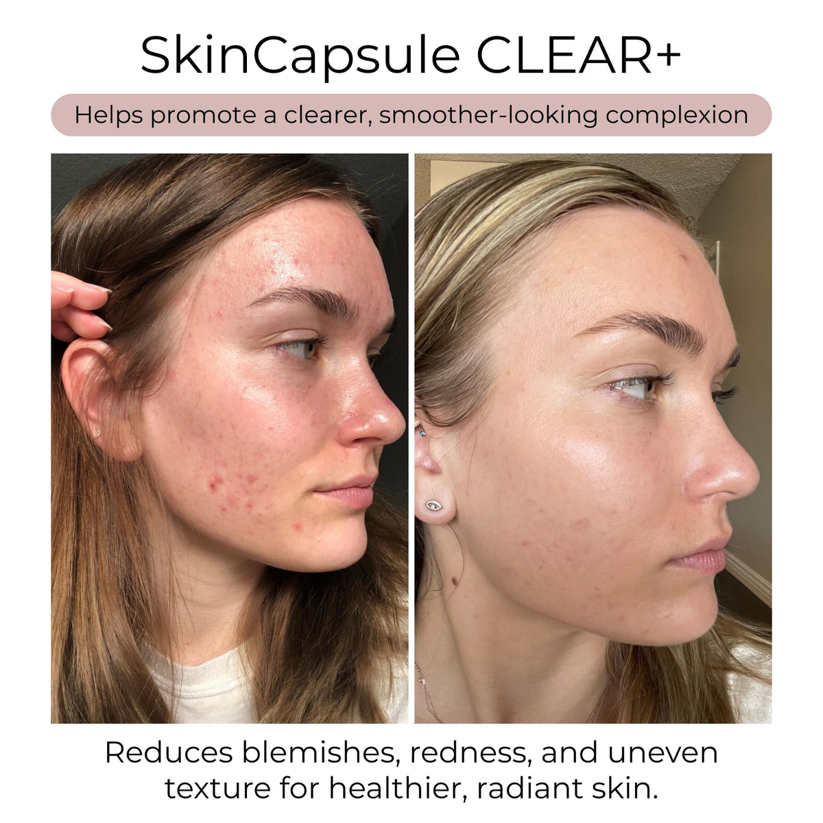 Hush & Hush Acne Supplement for Clear Skin - 60 Capsules - image 3