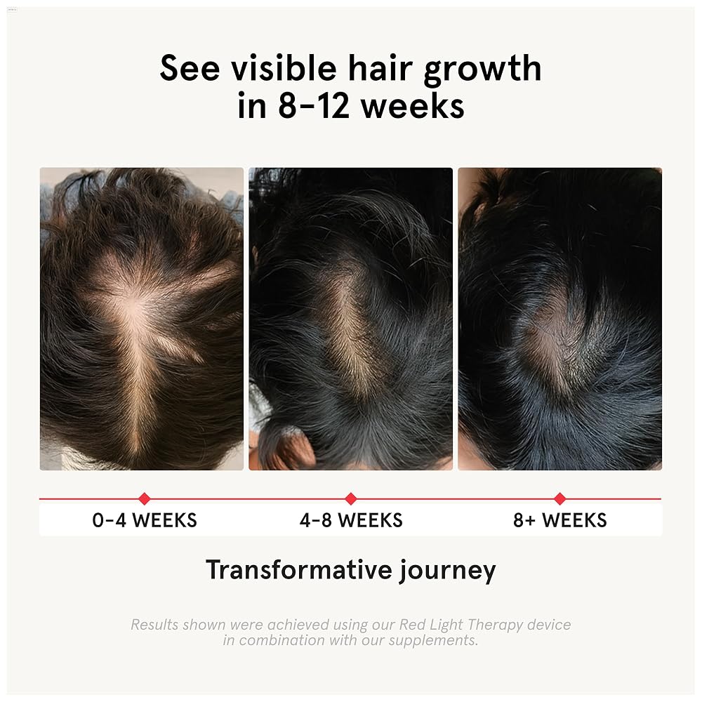 iRESTORE Hair Growth Supplement - Hair Loss Vitamins for Women