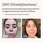 MDacne DIM Supplements for Hormonal Acne & Estrogen Balance - 30 Capsules - image 3