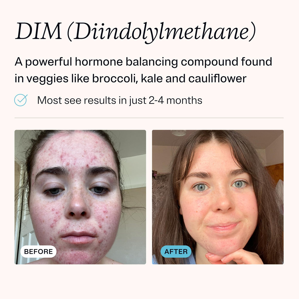 MDacne DIM Supplements for Hormonal Acne & Estrogen Balance - 30 Capsules - image 3
