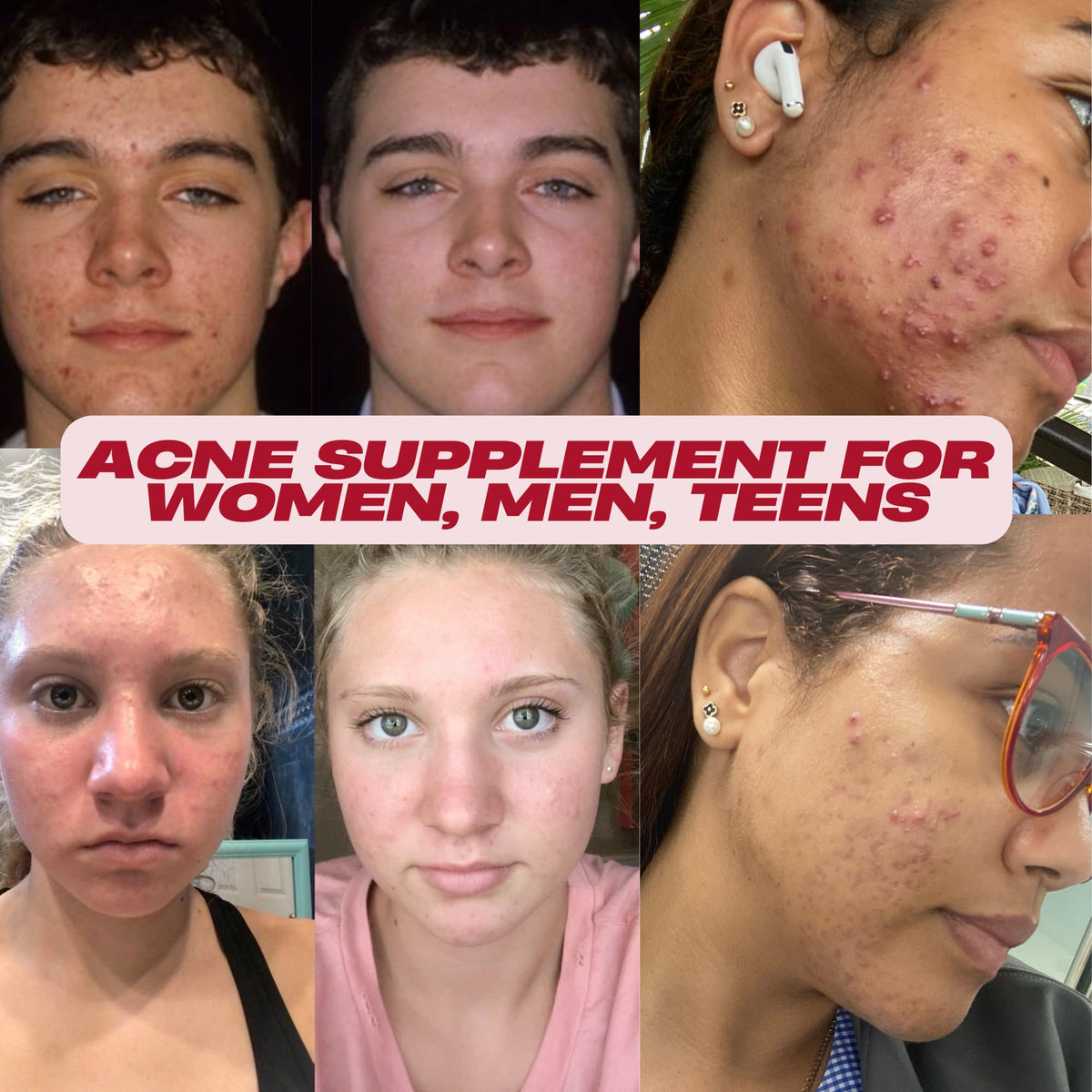 Acnetame Acne Pills Supplement for Skin Clarity - 60 Tablets - image 2