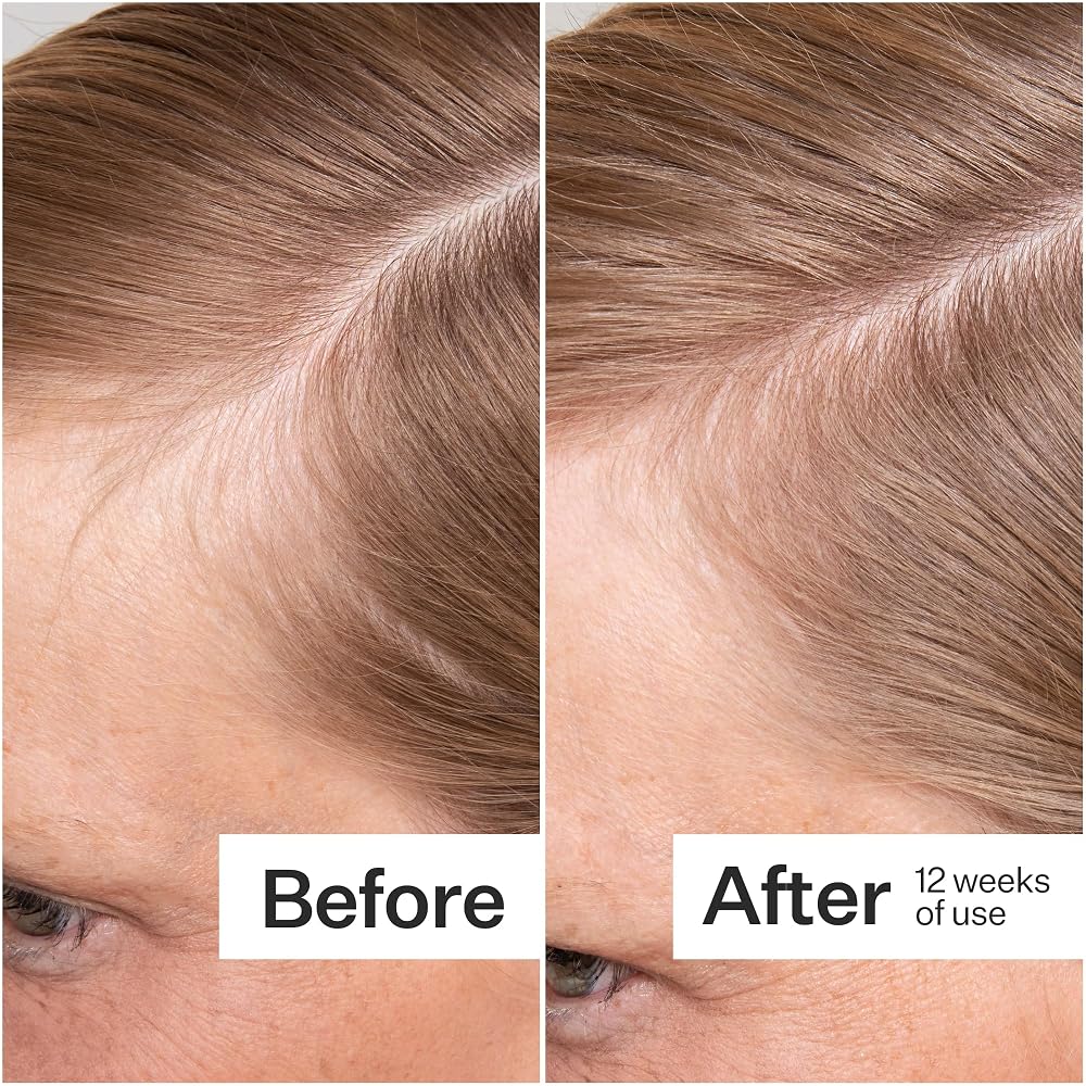 ACT+ ACRE Thick + Full Hair Capsules Biotin Supplement - 60 Count - image 4